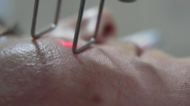 Extreme close up shot of Beautician cosmetologist doing procedure fractional microneedle mesotherapy rejuvenation with laser technology. Hardware cosmetology in clinic salon for client.