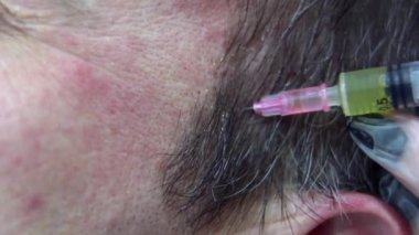 Modern kozmetik kliniğinde saç terapisinin makro aşısı, plazma enjeksiyonları. Orta yaşlı erkek hasta prp prosedürü. Saç uzatmak için. Güzellik konsepti.