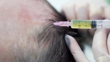 Modern kozmetik kliniğinde saç terapisinin makro aşısı, plazma enjeksiyonları. Orta yaşlı erkek hasta prp prosedürü. Saç uzatmak için. Güzellik konsepti.