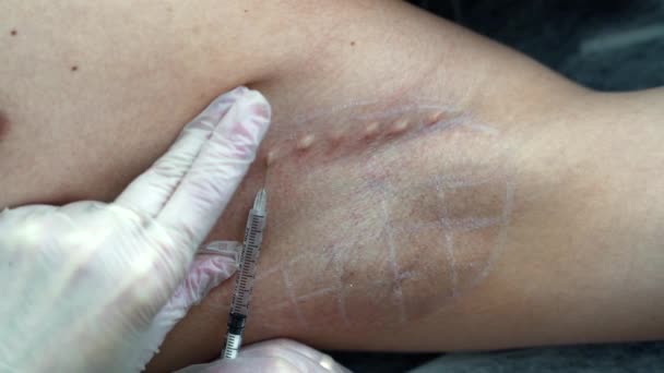 Close Shot Doctor Injeta Botox Uma Axila Pacientes Para Reduzir — Vídeo de Stock