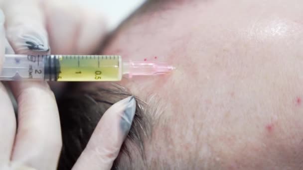 現代の美容クリニックでのヘアメソセラピー手順のマクロショット 血漿注射 中年男性の患者の髪の成長のための準備手順 美の概念 — ストック動画