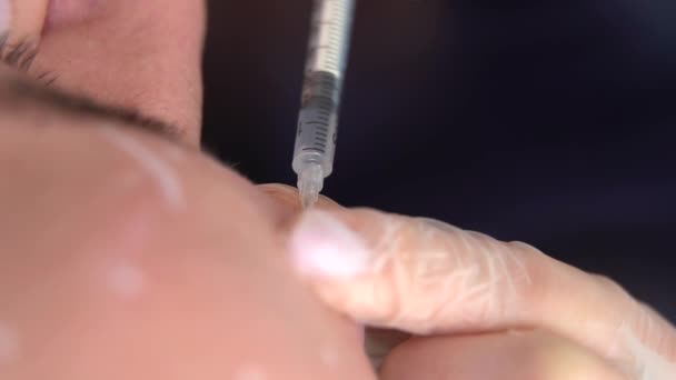 Vertikal Video Beautician Läkare Gör Botox Injektion Pannan Ung Vacker — Stockvideo