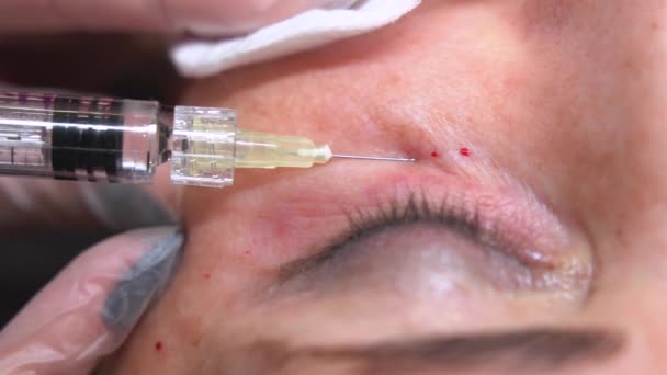 Lekarz Kosmetolog Wykonujący Wielokrotne Zastrzyki Biorewitalizacja Skórze Twarzy Kobiety Pod — Wideo stockowe