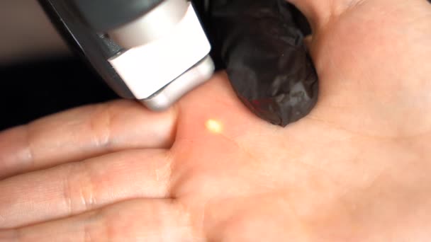 Detailní Záběr Kosmetologa Rukavicích Odstraní Bradavici Laserovou Technologií Dlaně Pacienta — Stock video