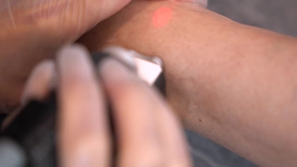 Penghapusan Pembuluh Darah Dengan Laser Vaskular Penghapusan Bintik Bintik Merah — Stok Video