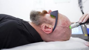 Sakallı cesur adam kafa tüy dökücü lazer temizleme işlemi, acısız prosedür, güzellik konsepti, Alexandrite lazer.