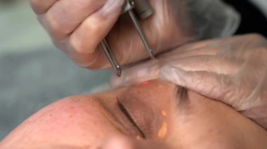 Cildiyeci doktor kadın hastanın yüzündeki Xanthelasma 'yı modern teknoloji CO2 lazer cihazıyla çıkarıyor. 4K yakın çekim. Güzellik ve sağlık hizmeti kavramı.