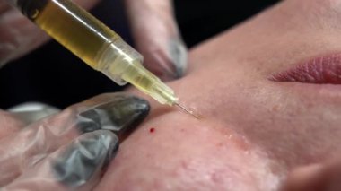 Kozmetik uzmanı kadın vücuduna birden fazla enjeksiyon yapıyor. Cilt elmacık kemiği, yakın çekim. Güzellik kliniğinde mezoterapi ve yüz gerdirme. Güzellik uzmanlarının elleri ve kızların yüzü.