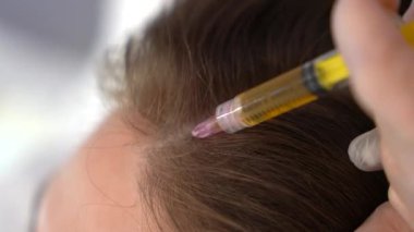 Doktor sağlıklı saç büyümesi için plazma terapisi uygular. Profesyonel tıp çalışanı, plazma tedavisi için küçük şırınga iğnesi kullanır. Güzellik, sağlık ve cilt bakımı. 4k