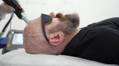 Sakallı cesur adam kafa tüy dökücü lazer temizleme işlemi, acısız prosedür, güzellik konsepti, Alexandrite lazer.