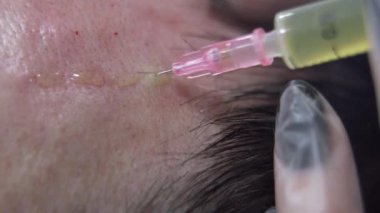 Modern kozmetik kliniğinde saç terapisinin makro aşısı, plazma enjeksiyonları. Orta yaşlı erkek hasta prp prosedürü. Saç uzatmak için. Güzellik konsepti.