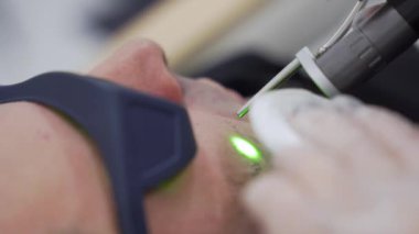 Close up man face epilation laser hair removal procedure treatment, unpainful procedure, beauty concept, alexandrite laser