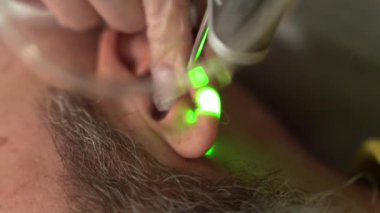 Cesur adamın kafa tüy dökücü lazer saçı kulaklarda. İskenderiye lazer tedavisi, acısız prosedür, güzellik konsepti, yakın çekim 4k görüntü.