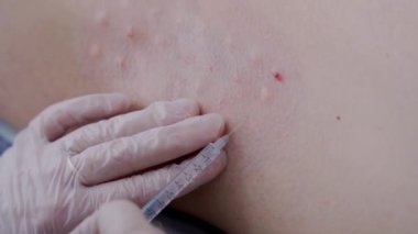 Doktorun, terlemeyi azaltmak için koltukaltına botulinyum toksini enjekte ettiği yakın çekim. Güzellik ve modern teknoloji kavramı.
