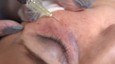Kozmetikçi doktor kadının yüzüne göz altı ve yakın çekim için birden fazla enjeksiyon yapıyor. Güzellik kliniğinde mezoterapi ve yüz gerdirme. Güzellik uzmanlarının elleri ve kızların yüzü.