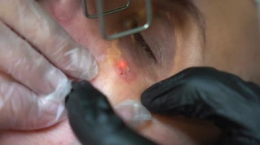Cildiyeci doktor kadın hastanın yüzündeki Xanthelasma 'yı modern teknoloji CO2 lazer cihazıyla çıkarıyor. 4K yakın çekim. Güzellik ve sağlık hizmetleri..