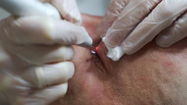 Bir dermatolog, modern bir lazer teknolojisi kliniğinde lazerle göz kapağındaki neoplazmayı, sağlık, güzellik ve bakım kavramını söker. 4k renk düzeltmeli çekimi kapat