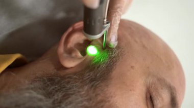 Cesur adamın kafa tüy dökücü lazer saçı kulaklarda. İskenderiye lazer tedavisi, acısız prosedür, güzellik konsepti, yakın çekim 4k görüntü.