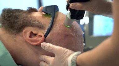 Sakallı cesur adam kafa tüy dökücü lazer temizleme işlemi, acısız prosedür, güzellik konsepti, Alexandrite lazer.