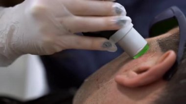 Close up man face epilation laser hair removal procedure treatment, unpainful procedure, beauty concept, alexandrite laser