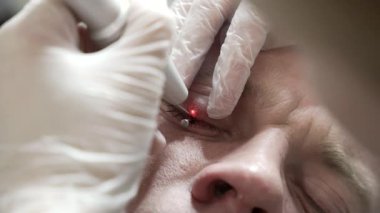 Bir dermatolog, modern bir lazer teknolojisi kliniğinde lazerle göz kapağındaki neoplazmayı, sağlık, güzellik ve bakım kavramını söker. 4k renk düzeltmeli çekimi kapat