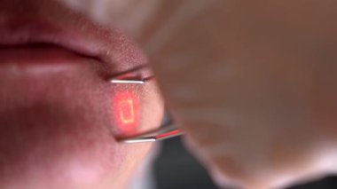 Güzellik uzmanı kozmetolojistin lazer teknolojisiyle mikroskopik mezonerapi yenileme prosedürünü çekerken aşırı yakın çekim. Klinikte müşteri için donanım kozmetolojisi.