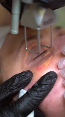 Cildiyeci doktor kadın hastanın yüzündeki Xanthelasma 'yı modern teknoloji CO2 lazer cihazıyla çıkarıyor. 4K dikey çekim. Güzellik ve sağlık hizmeti kavramı.