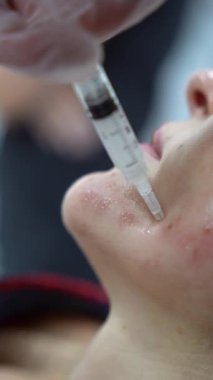 Dikey olarak, kozmetolog doktorun kadın yanağına birden fazla enjeksiyon yaparken 4k 'lık yakın çekimi. Güzellik kliniğinde mezoterapi ve yüz gerdirme. Güzellik uzmanlarının elleri ve kızların yüzü.