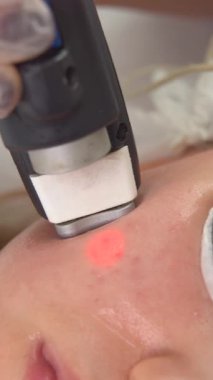 Damar lazeriyle kan damarlarının çıkarılması. Beyaz bir kadının yüzünde kırmızı lekeler, rosacea, kan damarları çıkarılmış. Lazer aygıtı. Bacağındaki kan damarlarının lazerle alınması.