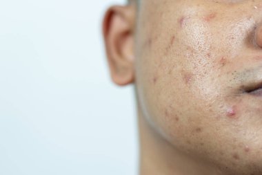 Deri sorunları. Yüzünde iltihaplı sivilce sorunu var. İltihaplı akne, şişkinlik, kızarıklık ve bakteri, yağ ve ölü deri hücreleriyle tıkanmış gözeneklerden oluşur..