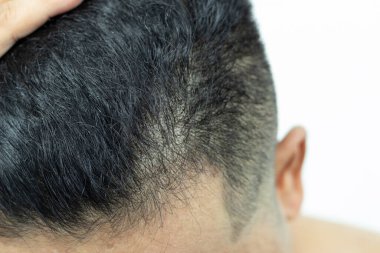 Yakından Gençler saç dökülmesi, kuruluk, donukluk, kırık uçlar ve hasar sorunları yaşıyor.