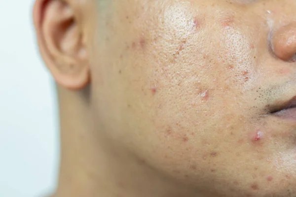 skin problems. problem of inflamed acne on the face. Inflamed acne consists of swelling, redness, and pores that are severely clogged with bacteria, oil, and dead skin cells.