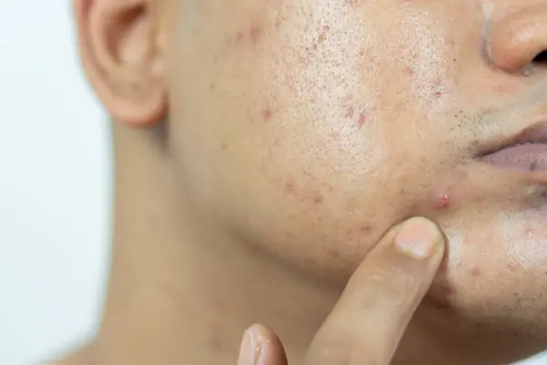 skin problems. problem of inflamed acne on the face. Inflamed acne consists of swelling, redness, and pores that are severely clogged with bacteria, oil, and dead skin cells.