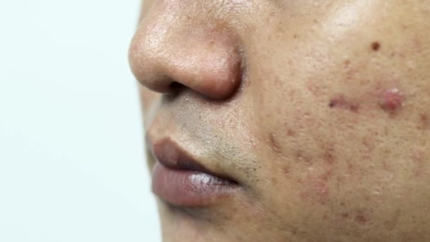 Skin Problems Problem Inflamed Acne Face Inflamed Acne Consists Swelling — Stock Video