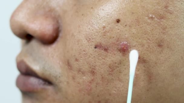 Hautprobleme Nahaufnahme Von Entzündeten Akne Problem Auf Asiatischen Mann Gesicht — Stockvideo