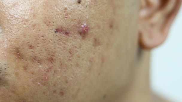 Hautprobleme Nahaufnahme Von Entzündeten Akne Problem Auf Asiatischen Mann Gesicht — Stockvideo