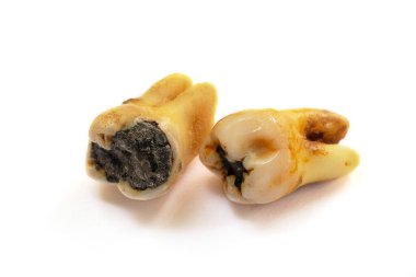 Kötü ağız hijyeninden dolayı diş bakımı veya çürüğü olarak da bilinen, beyaz arka planda izole edilmiş, yakın plan dişli bir diş.