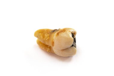 Kötü ağız hijyeninden dolayı diş bakımı veya çürüğü olarak da bilinen, beyaz arka planda izole edilmiş, yakın plan dişli bir diş.