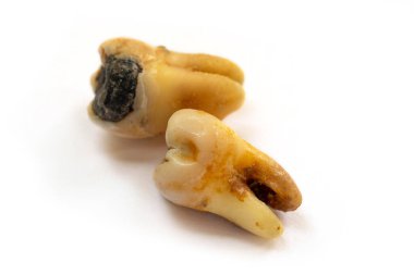 Kötü ağız hijyeninden dolayı diş bakımı veya çürüğü olarak da bilinen, beyaz arka planda izole edilmiş, yakın plan dişli bir diş.