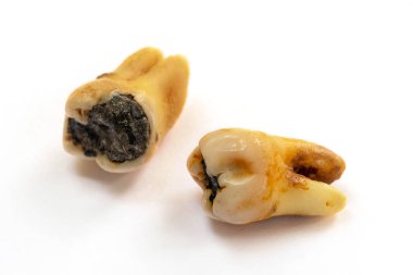 Kötü ağız hijyeninden dolayı diş bakımı veya çürüğü olarak da bilinen, beyaz arka planda izole edilmiş, yakın plan dişli bir diş.