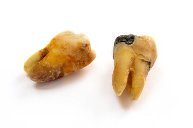 Kötü ağız hijyeninden dolayı diş bakımı veya çürüğü olarak da bilinen, beyaz arka planda izole edilmiş, yakın plan dişli bir diş.