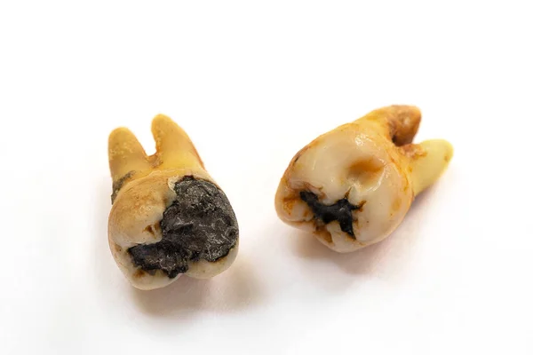 Ένα Κοντινό Δόντι Σοβαρή Τερηδόνα Επίσης Γνωστή Τερηδόνα Κοιλότητες Λόγω — Φωτογραφία Αρχείου