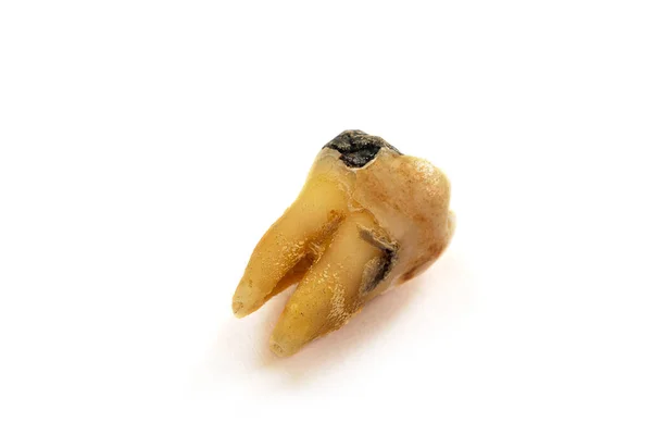 蛀牙一种因口腔卫生差而严重蛀坏的近牙 也被称为蛀牙或蛀牙 在白色背景下被隔离 — 图库照片