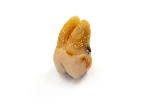 Ένα Κοντινό Δόντι Σοβαρή Τερηδόνα Επίσης Γνωστή Τερηδόνα Κοιλότητες Λόγω — Φωτογραφία Αρχείου