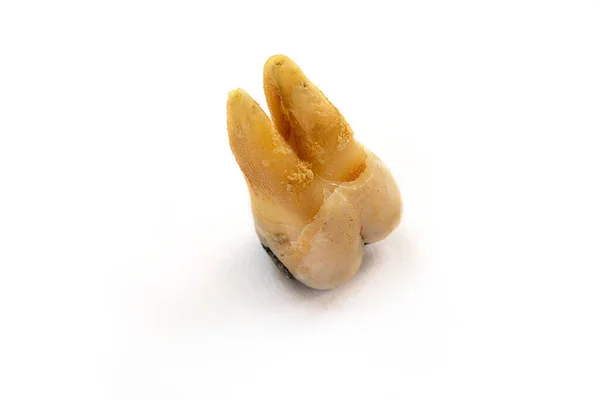 Dente Perto Com Cárie Dentária Severa Também Conhecida Como Cárie — Fotografia de Stock