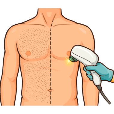 Bir adamın göğsünün lazer tüyü alınırken ki temsili görüntüsü. Beyaz arka planda temiz ve estetik sanat eserleri var. Öncesi ve sonrası.