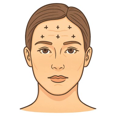 İşaretli Botoks enjeksiyon noktaları olan bir kadının vektör çizimi. Beyaz arka planda izole tasarım. Infographics veya kozmetik kliniği görsellerinde kullanmak için ideal.