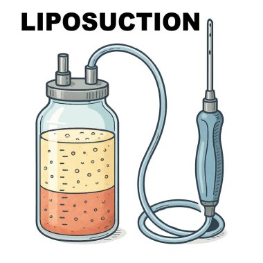 Liposuction ekipmanlarının vektör çizimi. Şeffaf bir vakum tüpü kısmen çıkarılmış yağ ile doludur, ayrık sıvı katmanlar gösterir. Tıbbi ve eğitici görseller için ideal.