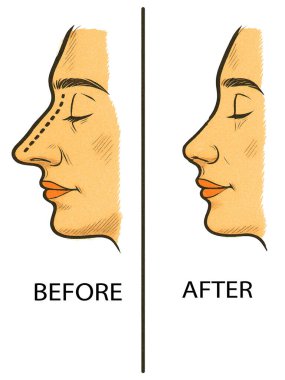 Burun estetiğinden önce ve sonra yapılan vektör çizimi. Beyaz arka planda izole tasarım. Tıbbi ve kozmetik görseller için ideal.