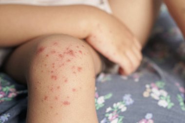 Close up view of Child's knee infected with hand feet and mouth disease or HFMD originating from enterovirus or coxsackie virus, red harsh on the skin. close up view zoom shot. clipart